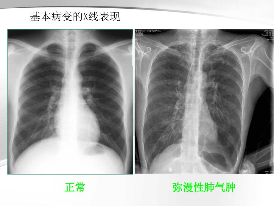 呼吸系统的异常影像学表现_第4页