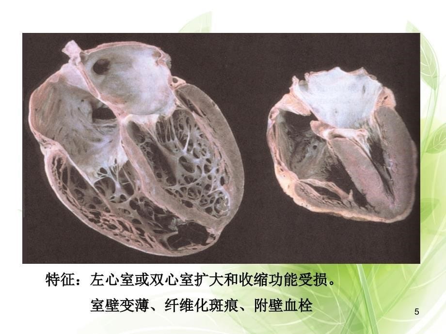 扩张型心肌病教学查房PPT课件_第5页