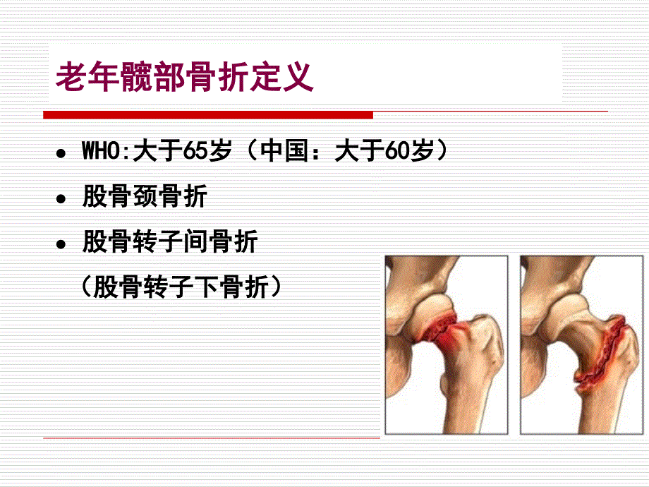 老年髋部骨折ppt课件_第4页