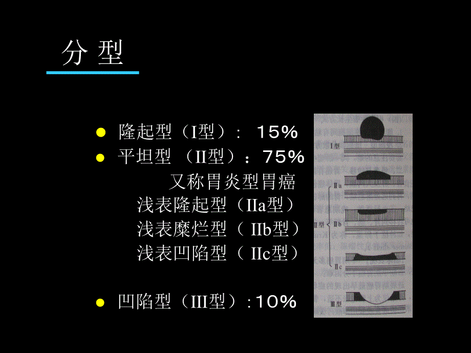 早期胃癌的诊治进展1_第4页