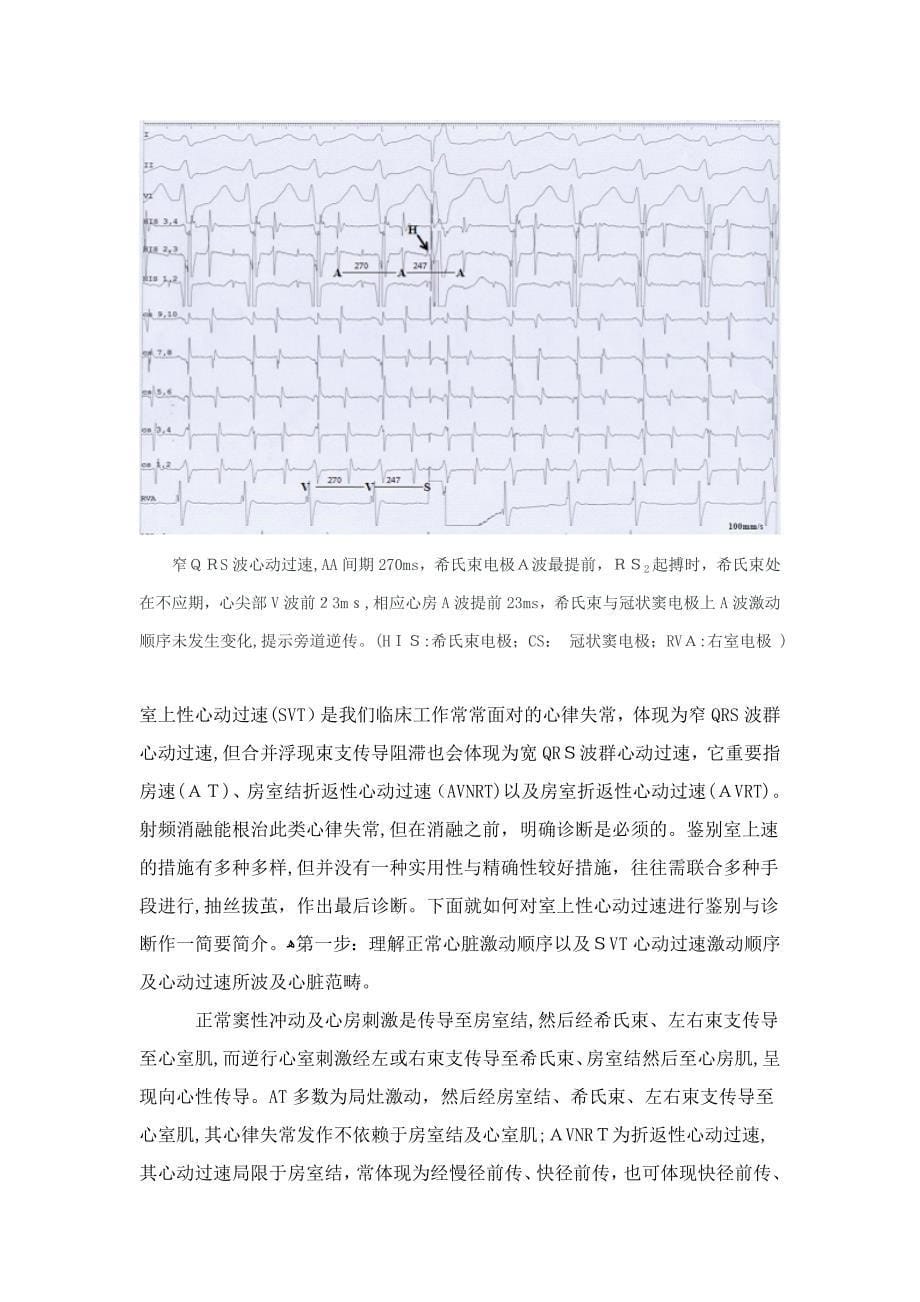 室上性心动过速鉴别诊断的常用心内电生理程序刺激方法_第5页