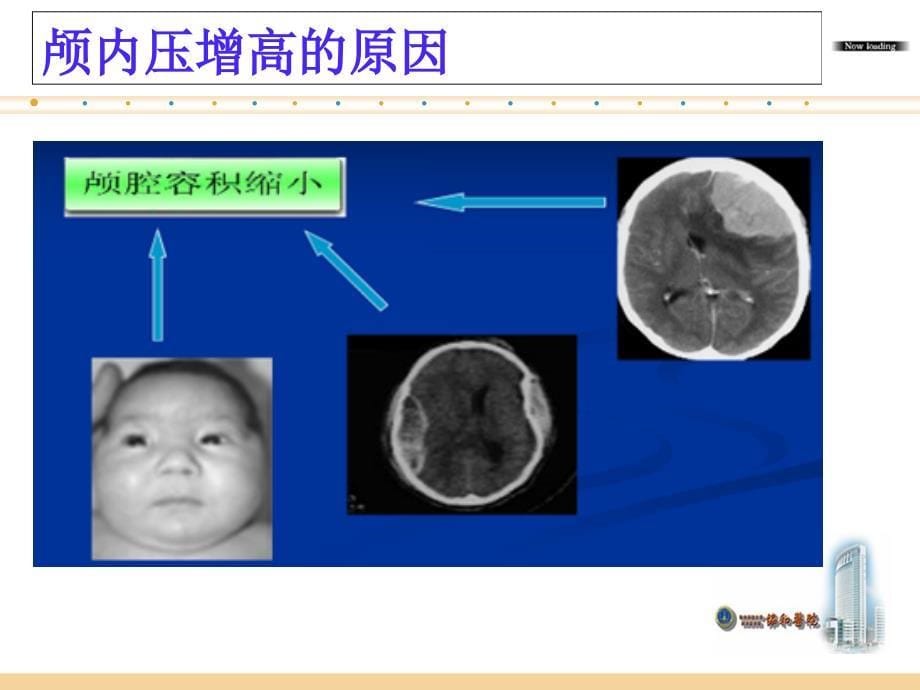 颅内高压的护理PPT课件_第5页