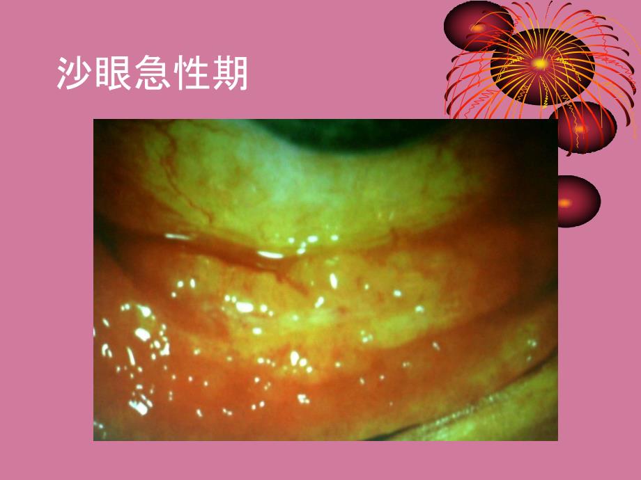 同仁张文华临床常见感染性结角膜疾病的诊断与治疗ppt课件_第3页