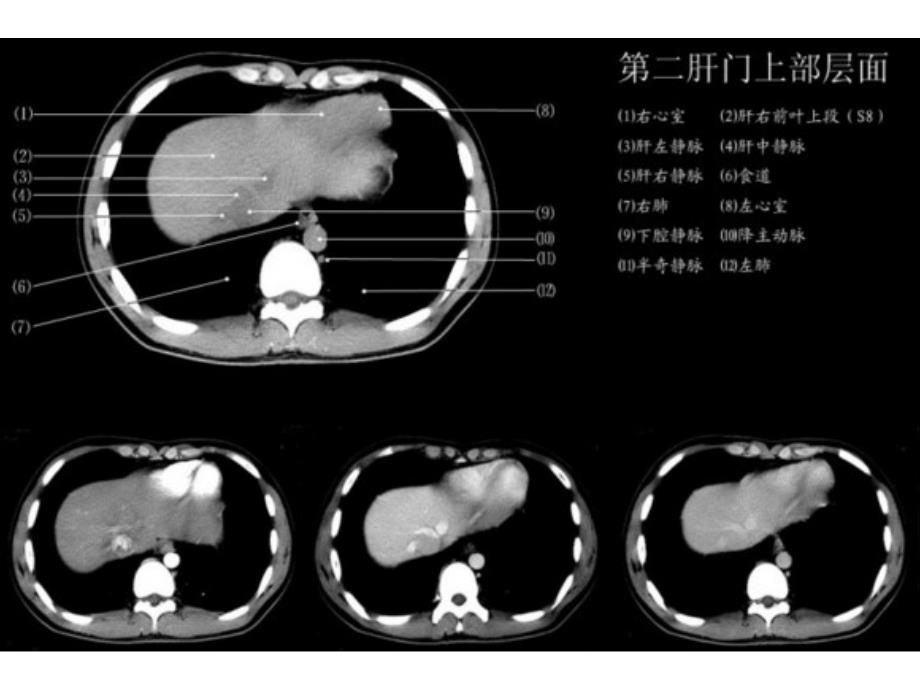 上腹部CT各个层面_第3页