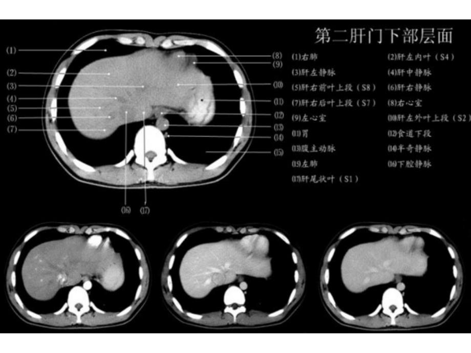 上腹部CT各个层面_第4页