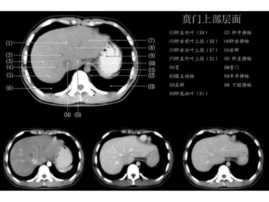 上腹部CT各个层面_第5页