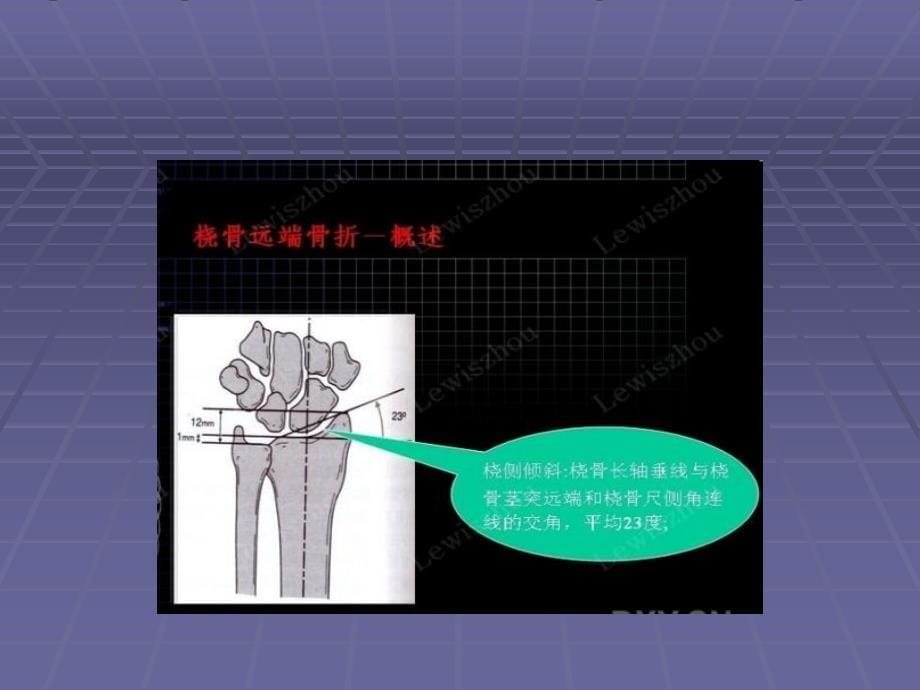 最新桡骨远端骨折.PPT文档_第5页