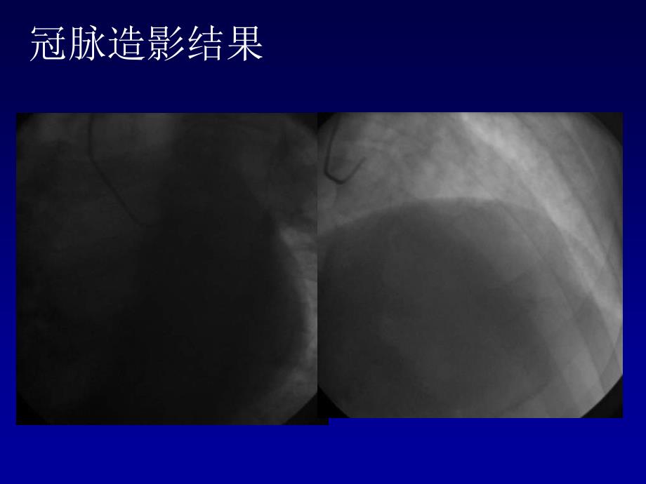 pci并发症处理一例告娄大元_第4页