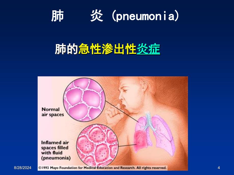 病理学：肺炎_第4页