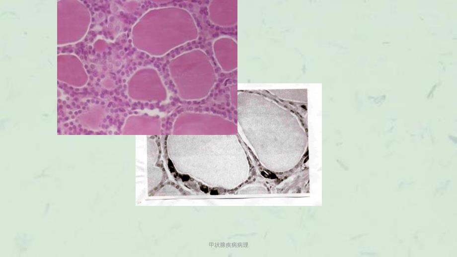 甲状腺疾病病理课件_第4页
