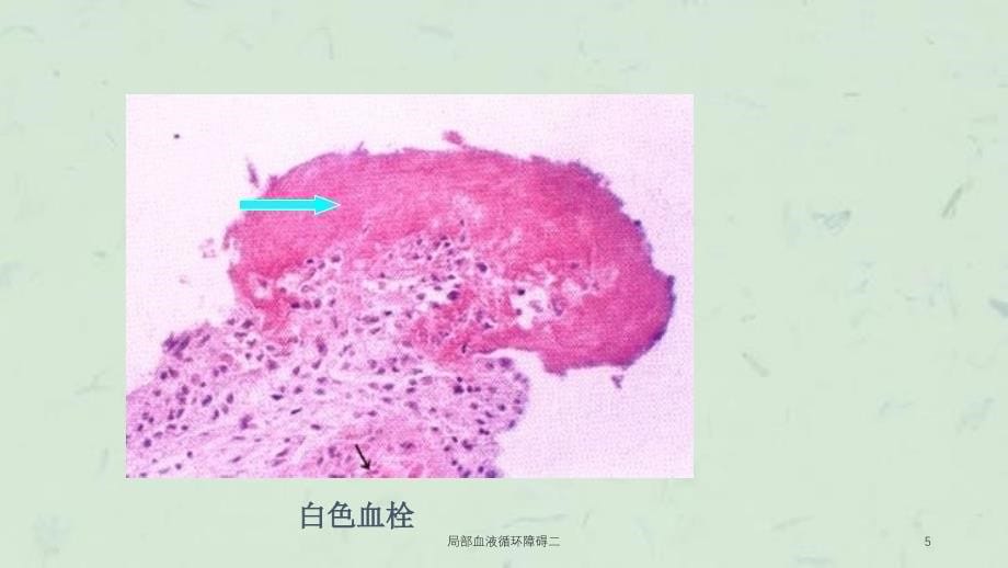 局部血液循环障碍二课件_第5页