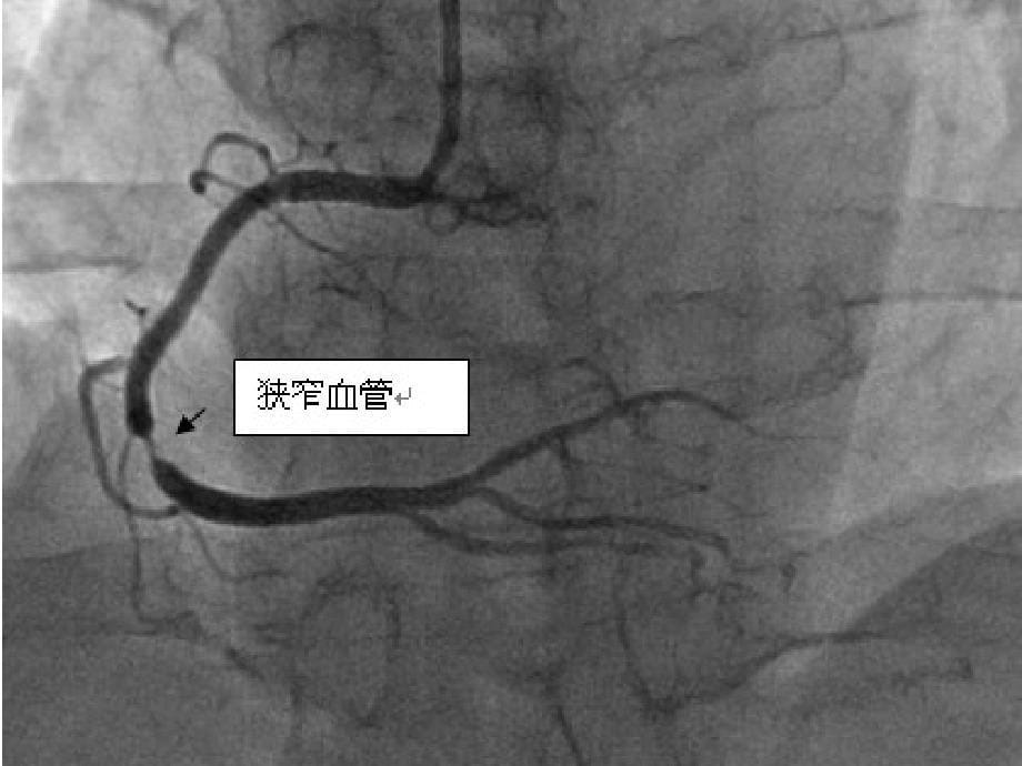 冠脉造影与支架置入术_第5页