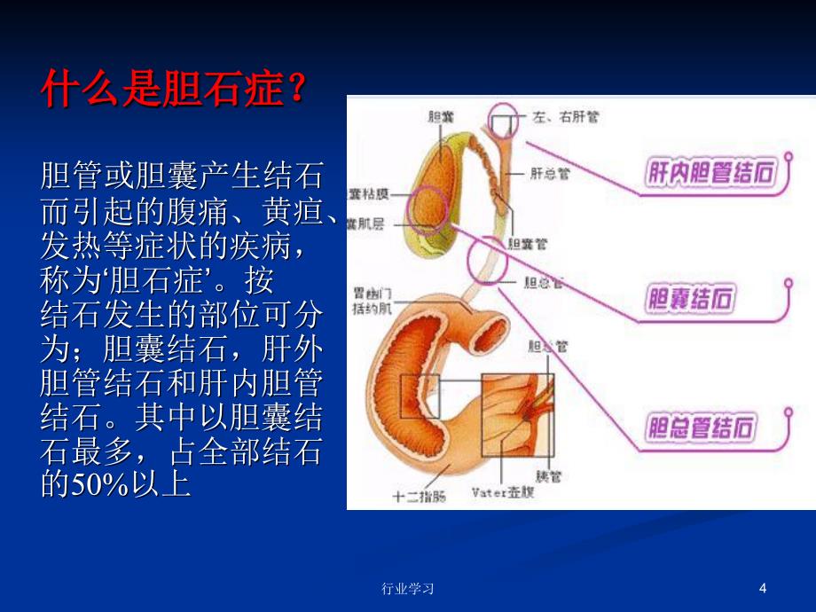 胆石症cholelithiasis含治疗术后饮食特制研究_第4页