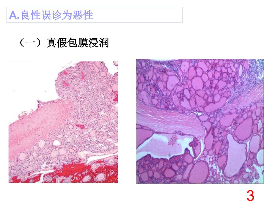 0402甲状腺诊断中的陷阱和免疫组化_第3页