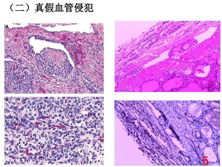 0402甲状腺诊断中的陷阱和免疫组化_第5页