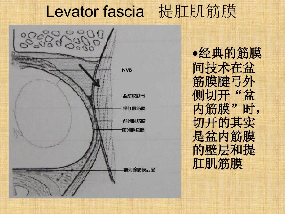 筋膜内根治性前列腺切除术.ppt_第2页