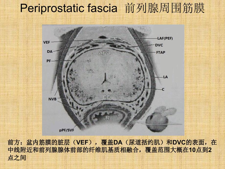 筋膜内根治性前列腺切除术.ppt_第3页