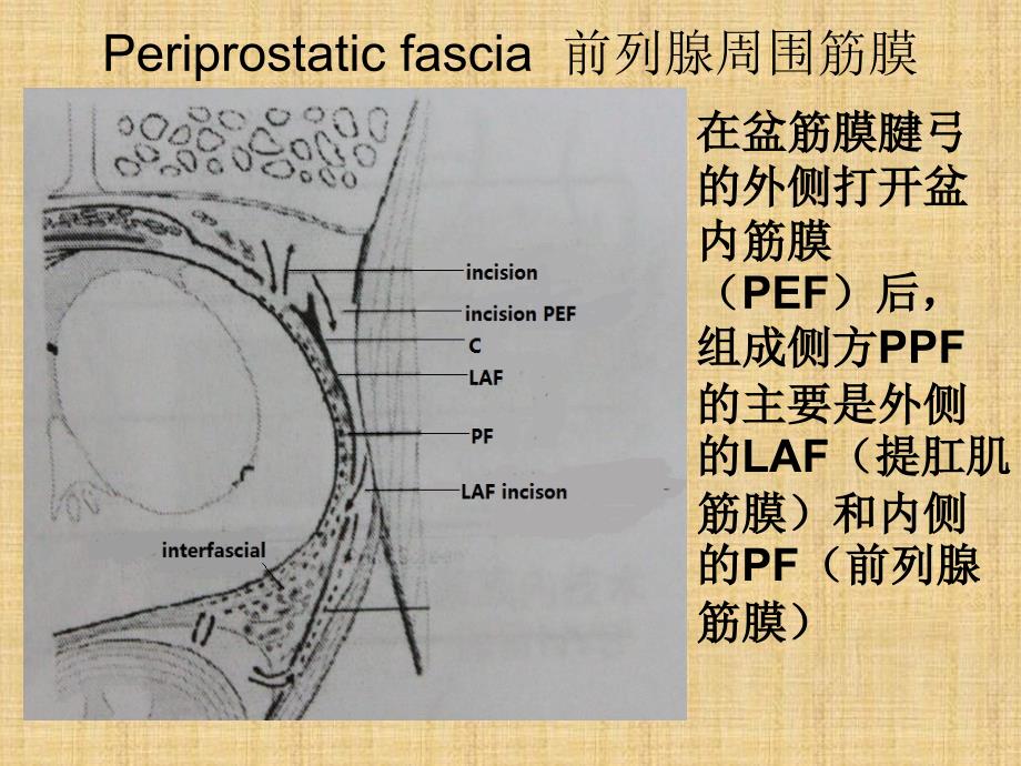 筋膜内根治性前列腺切除术.ppt_第4页