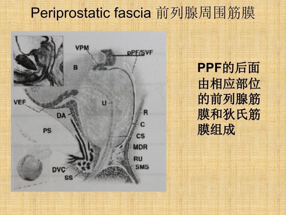 筋膜内根治性前列腺切除术.ppt_第5页