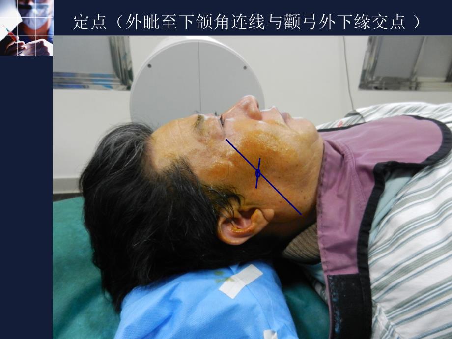 蝶腭神经节射频治疗交班_第4页