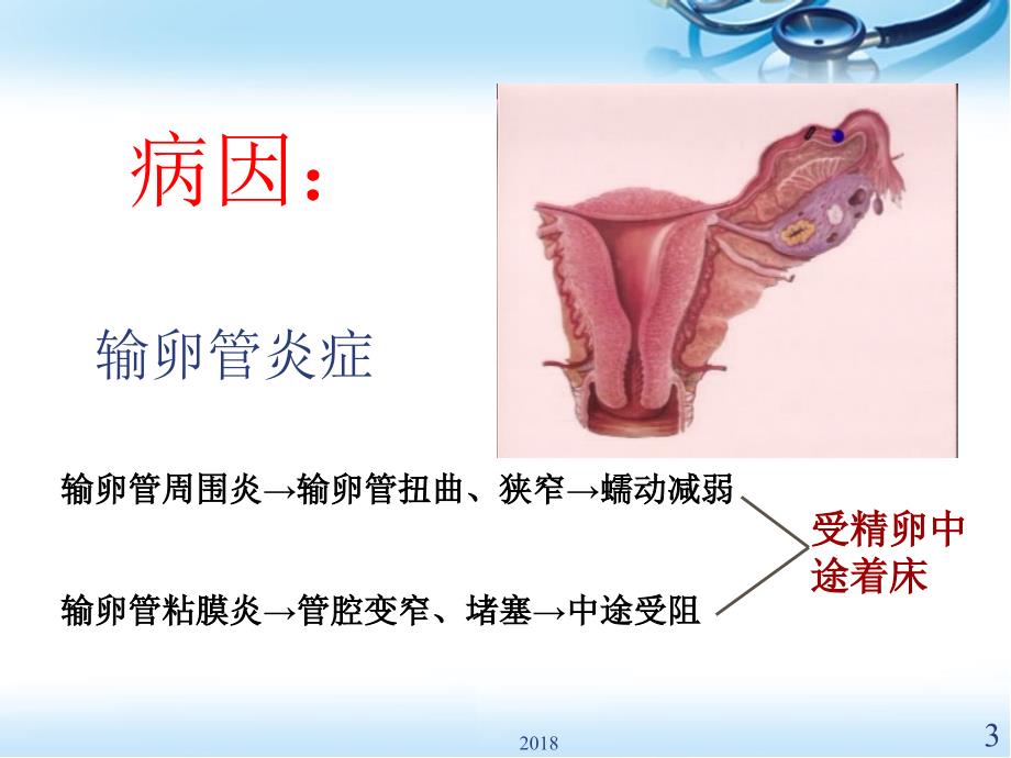 宫外孕的护理医学PPT课件_第3页