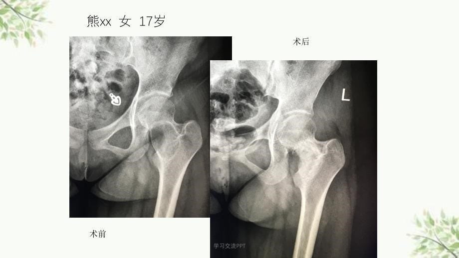 骨囊肿医学课件_第5页