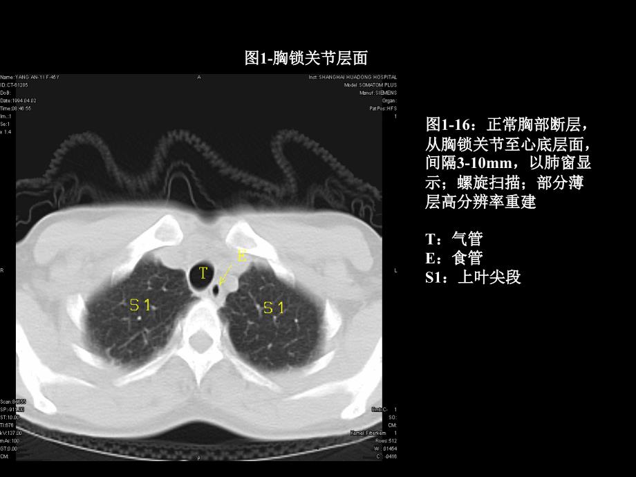 最全胸部CT肺段划分_第1页