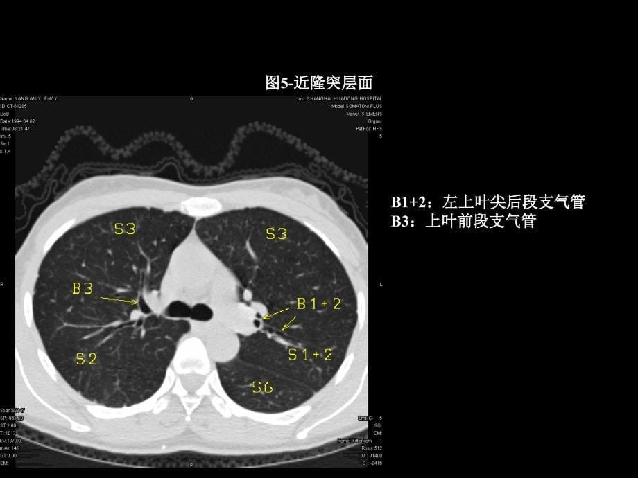 最全胸部CT肺段划分_第5页