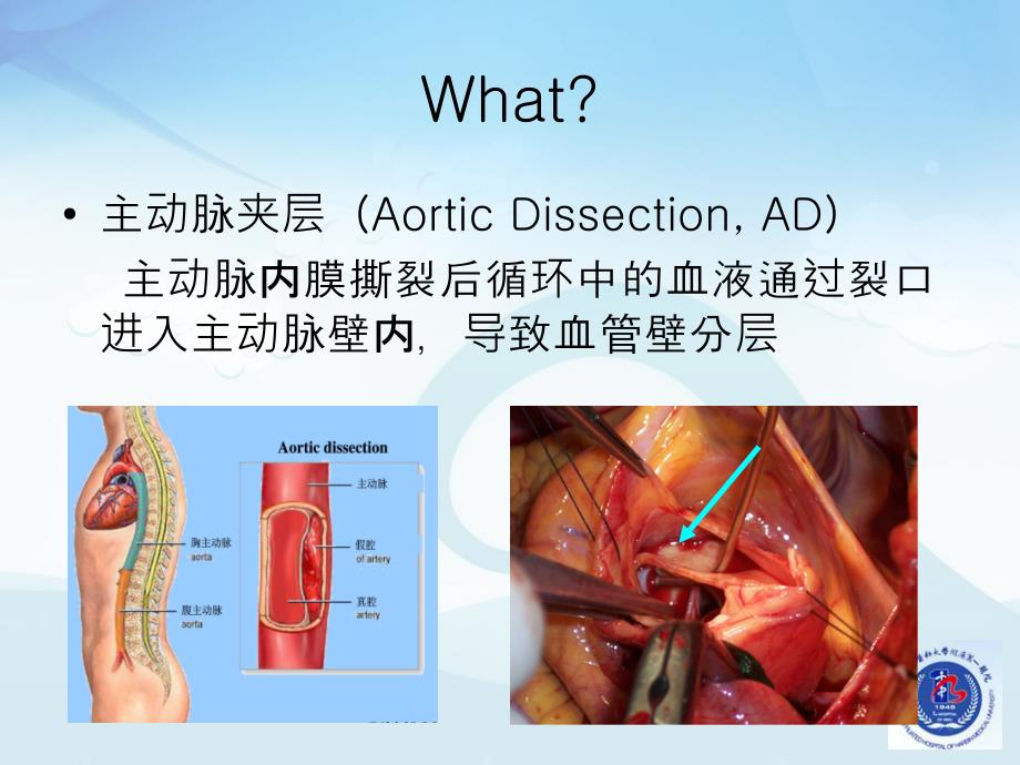 最新：主动脉夹层ppt课件文档资料_第2页