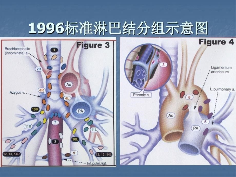 肺部淋巴结分组勾画幻灯1_第5页