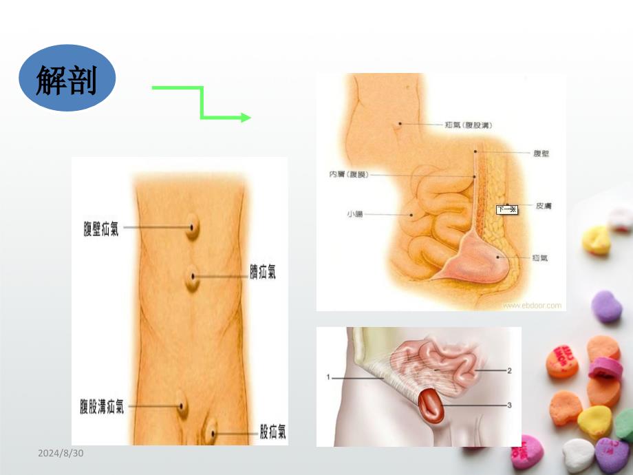 腹股沟疝术后护理_第4页