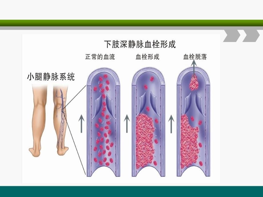 下肢深静脉血栓的护理查房_第5页