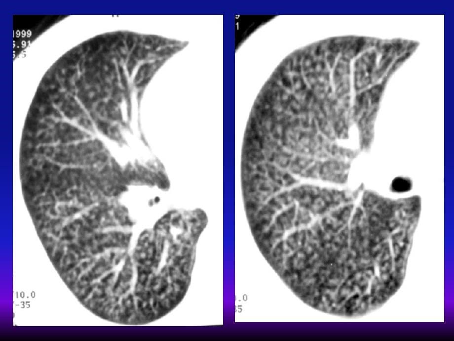 医学ppt弥漫性肺疾病的影像学诊断思路_第5页
