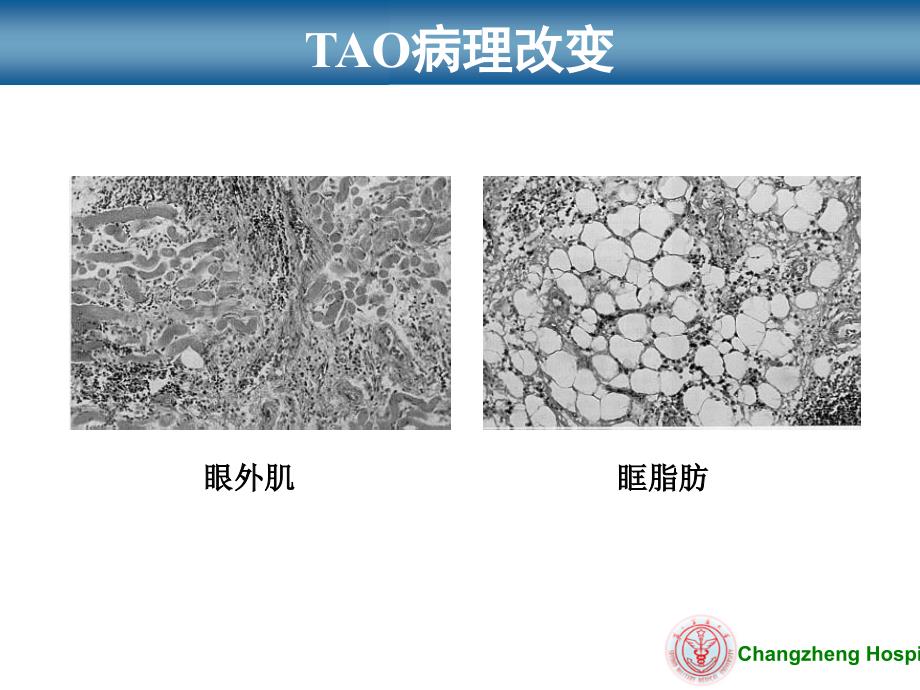 甲状腺相关性眼病新进展研究_第4页