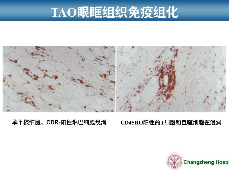 甲状腺相关性眼病新进展研究_第5页