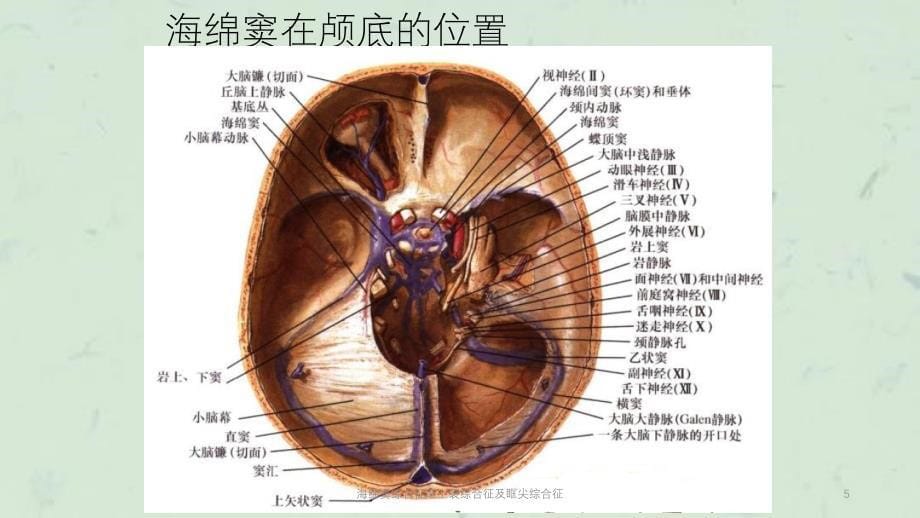 海绵窦综合征眶上裂综合征及眶尖综合征课件_第5页