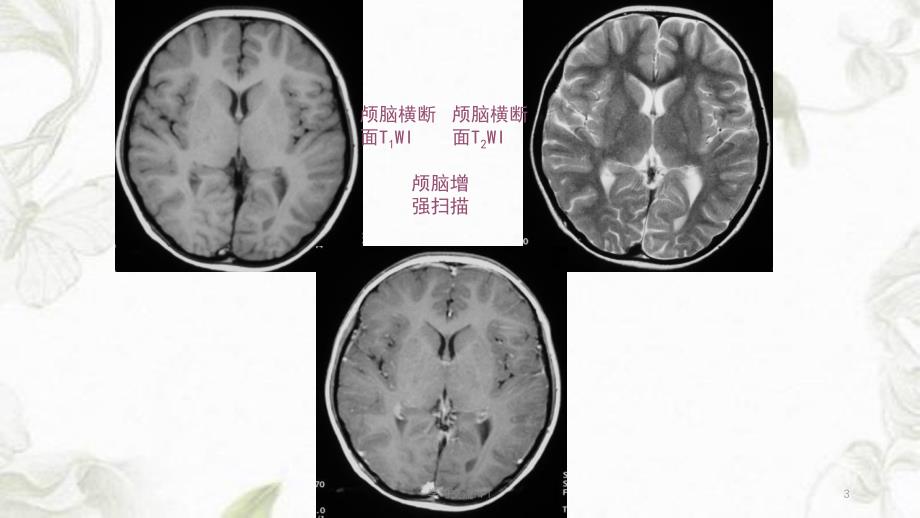 MRI中枢神经系统疾病MRI诊断ppt课件_第3页