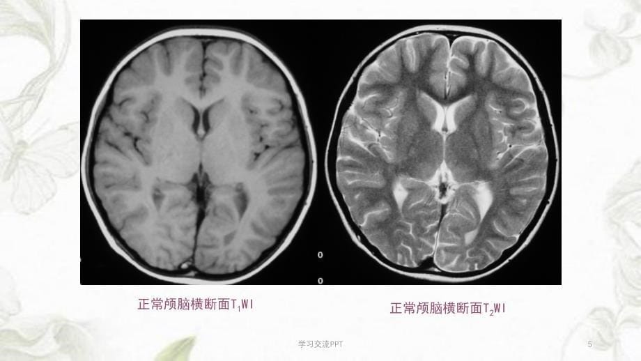 MRI中枢神经系统疾病MRI诊断ppt课件_第5页