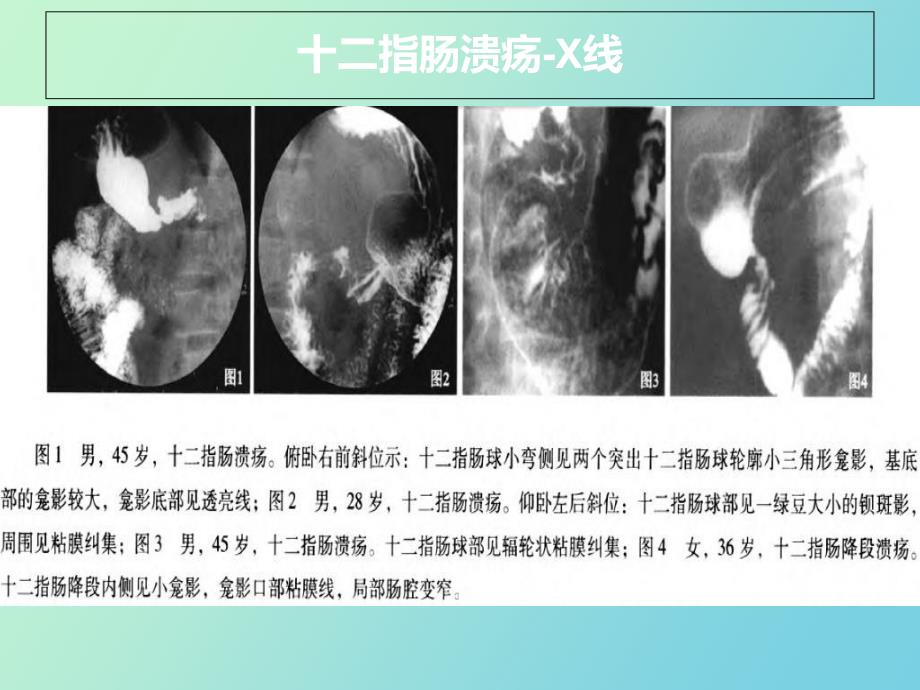 指肠常见病变影像诊断_第4页