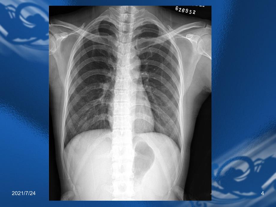 医学影像诊断学呼吸系统1PPT课件_第4页