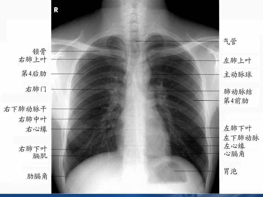 医学影像诊断学呼吸系统1PPT课件_第5页