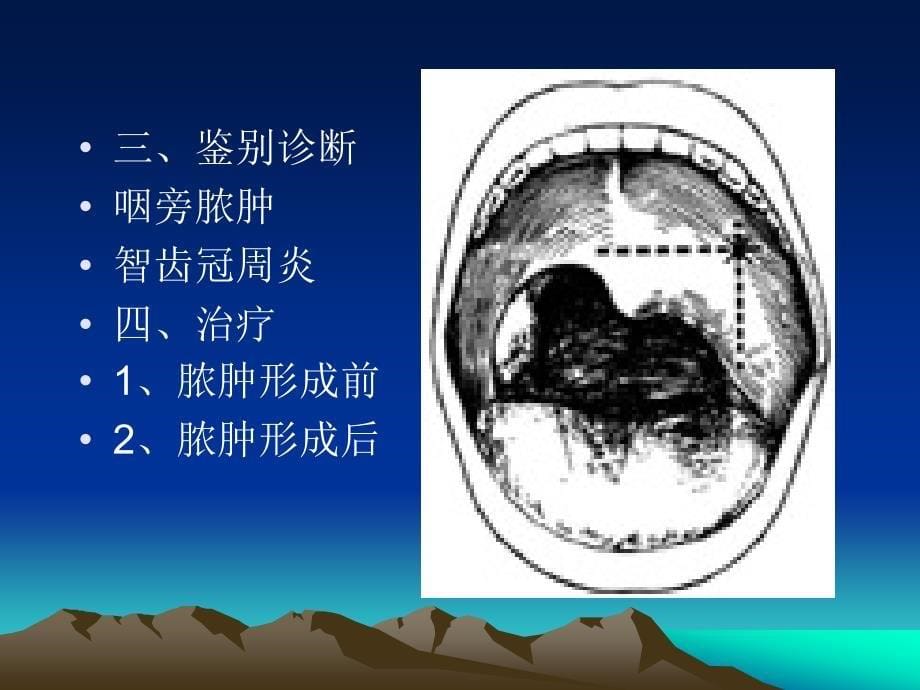 咽部脓肿PPT课件_第5页