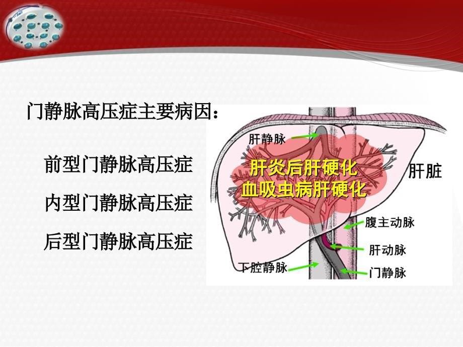 门静脉高压症患者的护理.ppt_第5页