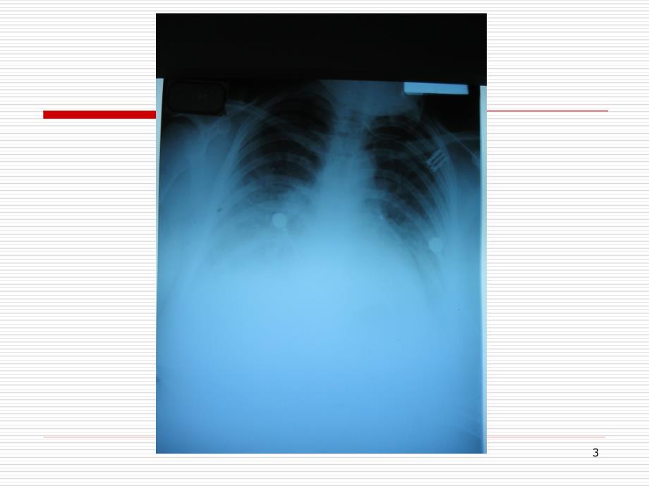 体外膜肺氧合(ECMO)与护理ppt参考课件_第3页