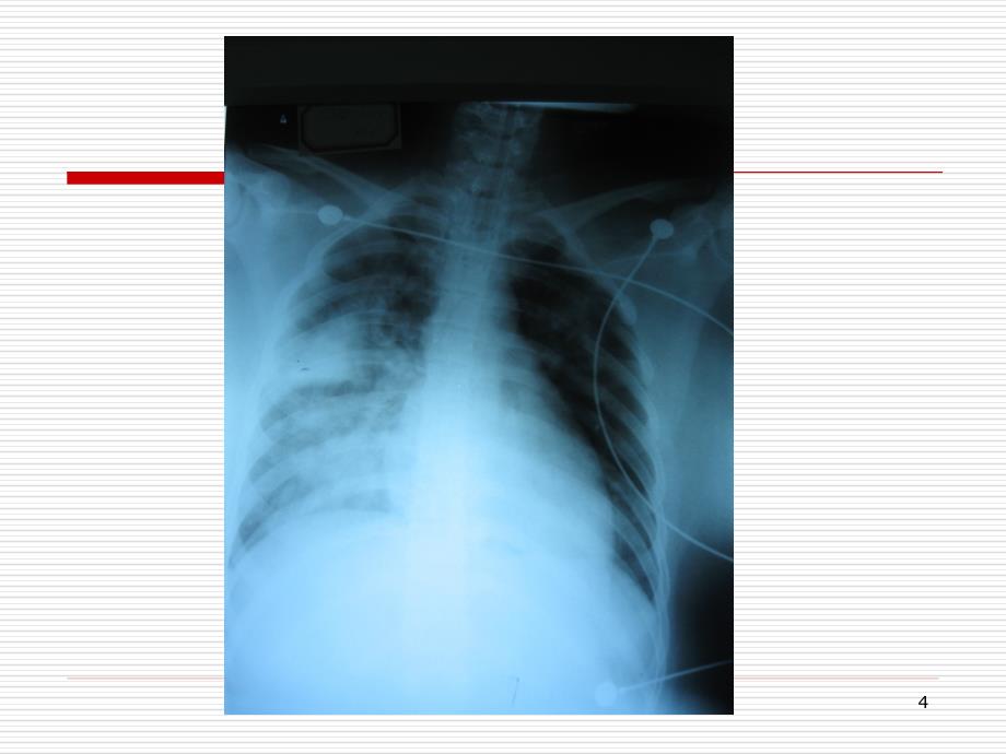 体外膜肺氧合(ECMO)与护理ppt参考课件_第4页