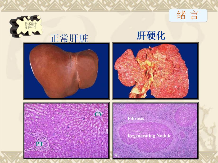 肝硬化的诊断和治疗ppt课件_第4页