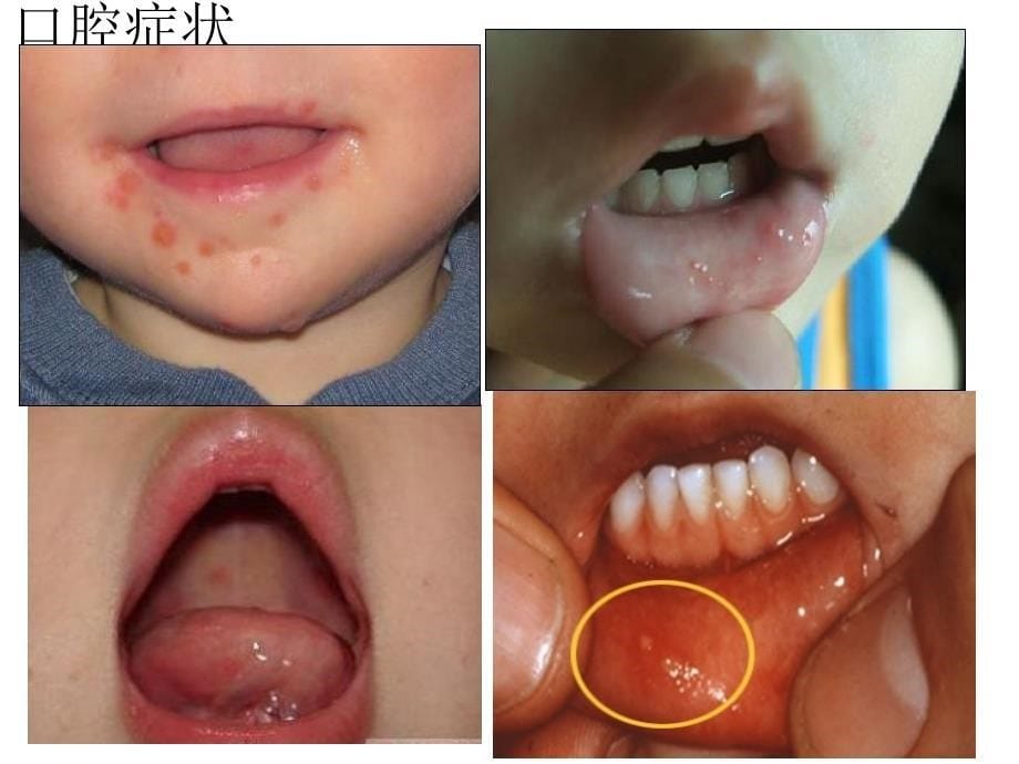 幼儿园健康教育手足口病的预防课件_第5页