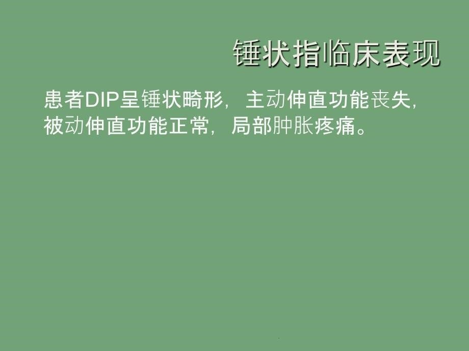 支具在锤状指康复中的应用_第5页