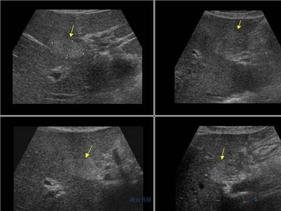 肝脏疾病超声诊断[行业特制]_第5页
