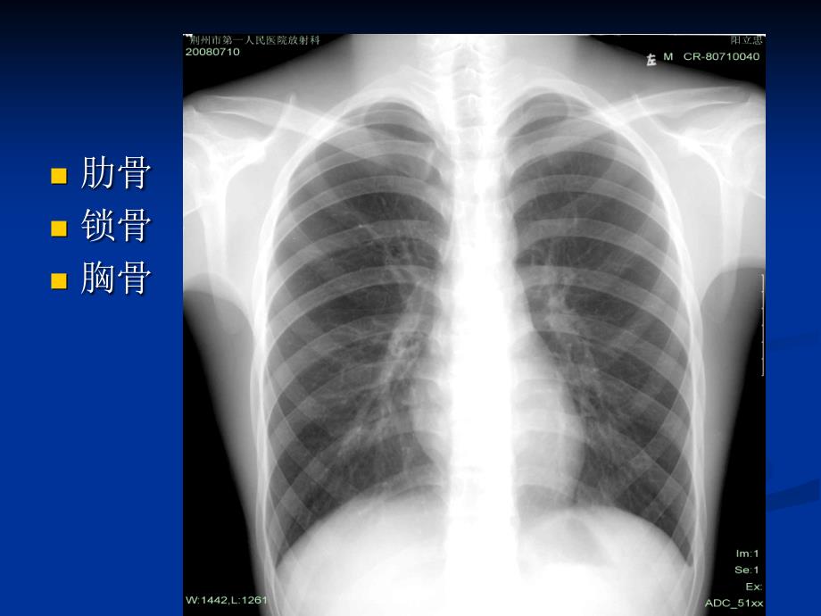 肺不张和肺实变_第2页